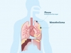 Pleural Mesothelioma Centre and Mesothelioma Support