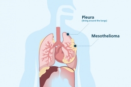 Pleural Mesothelioma Centre and Mesothelioma Support